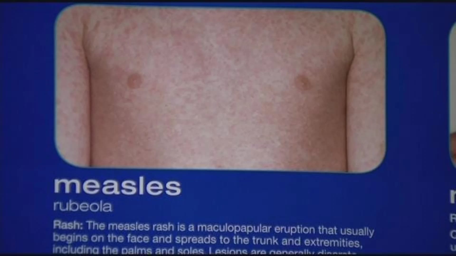 Rockland County declares state of emergency amidst measles outbreak